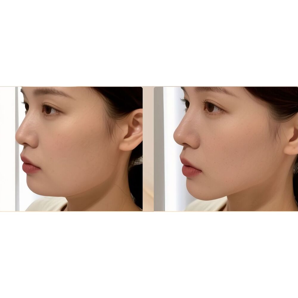 Appareil de yoga facial pour améliorer l'apparence des tempes, corriger l'atrophie des muscles de la mâchoire, renforcer la force de la morsure faciale et sculpter le contour du visage._voghion.com