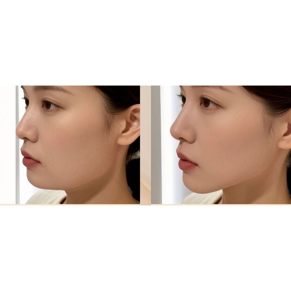 Appareil de yoga facial pour améliorer l'apparence des tempes, corriger l'atrophie des muscles de la mâchoire, renforcer la force de la morsure faciale et sculpter le contour du visage._voghion.com